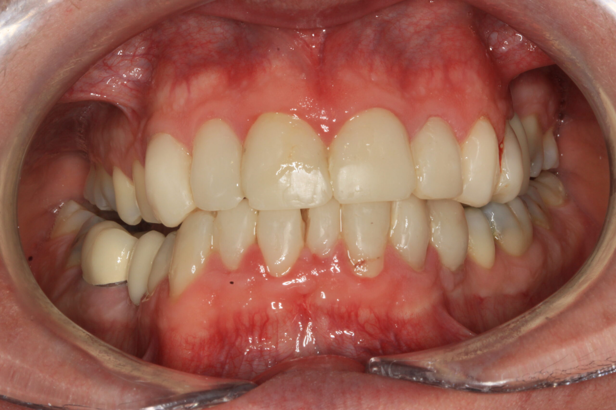 Acid Wear After scaled Dentist Daventry NHS Exempt and Independent