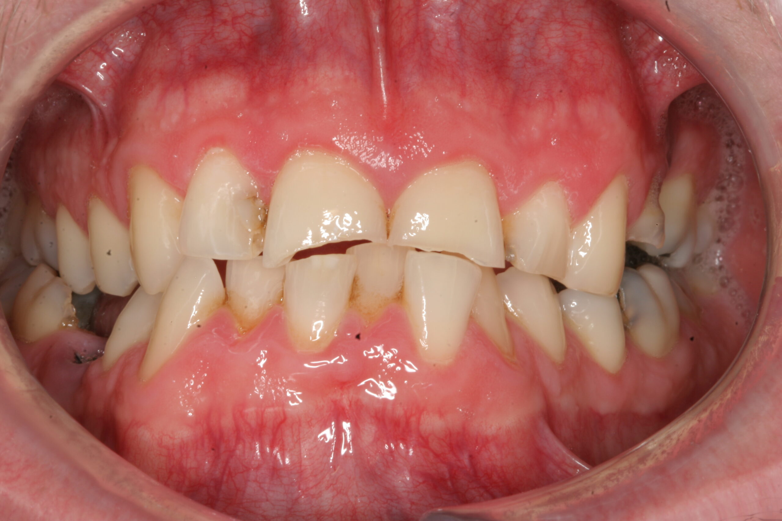 Acid Wear Before scaled Dentist Daventry NHS Exempt and Independent