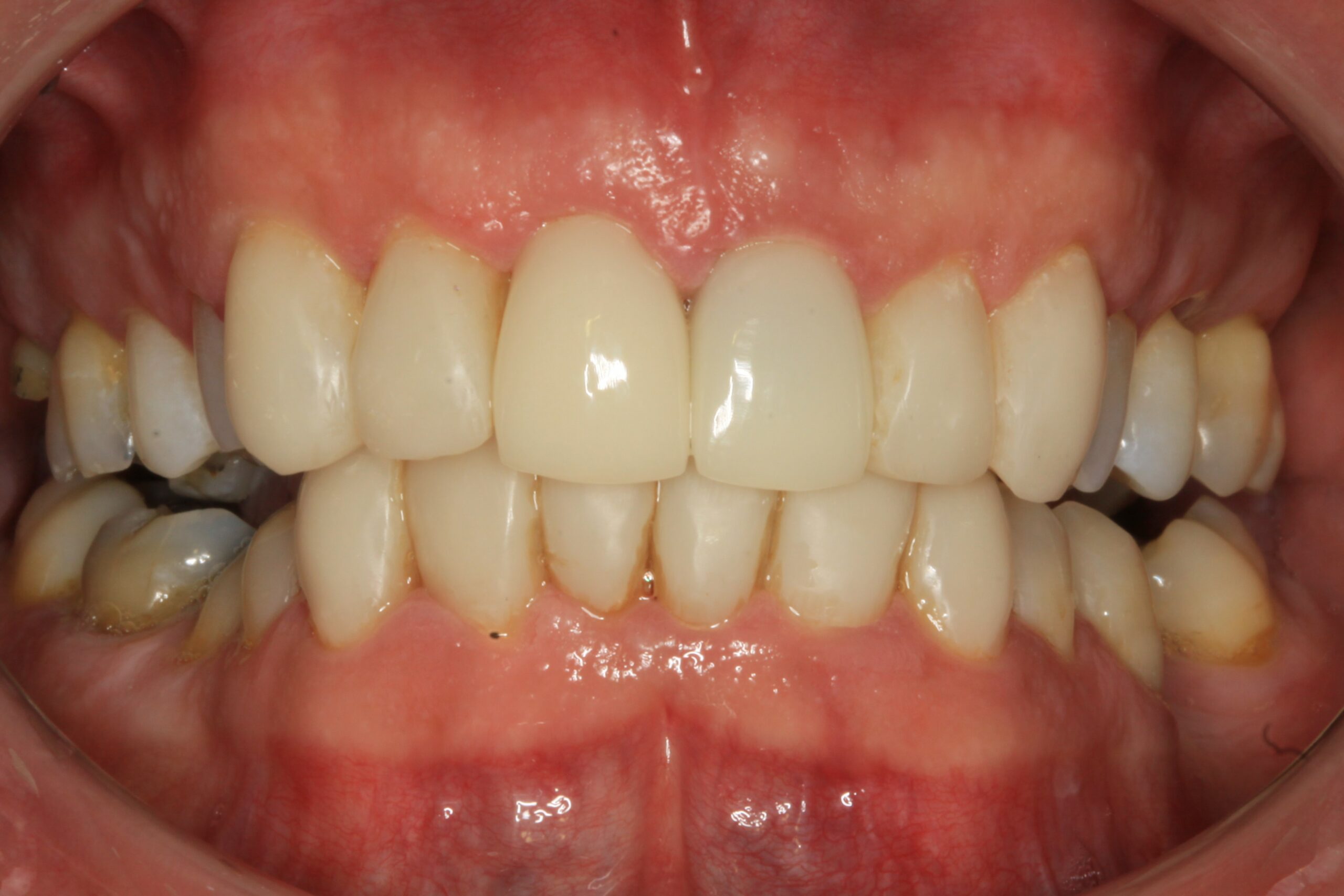 Composite Bonding After scaled Dentist Daventry NHS Exempt and Independent