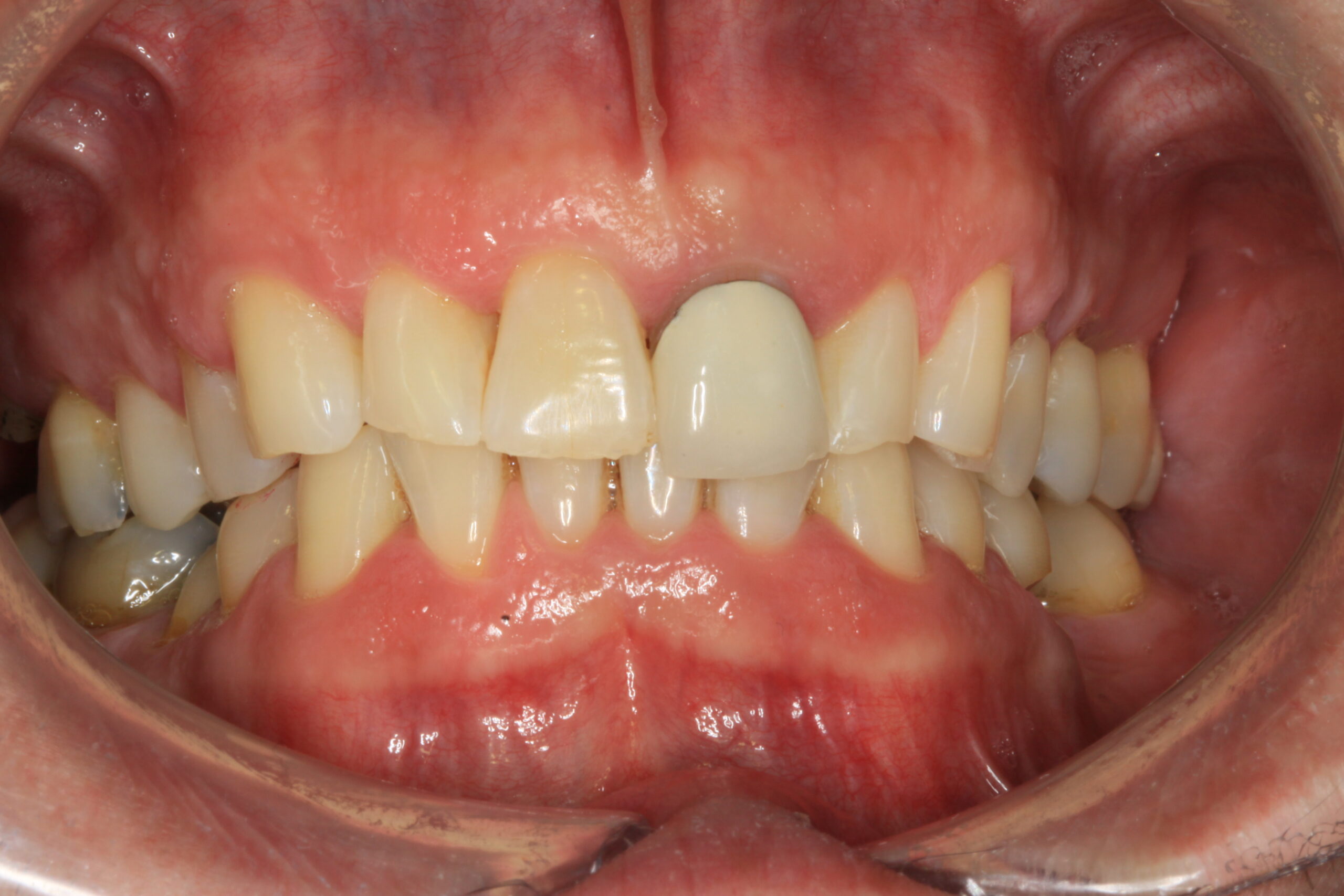 Composite Bonding Before scaled Dentist Daventry NHS Exempt and Independent