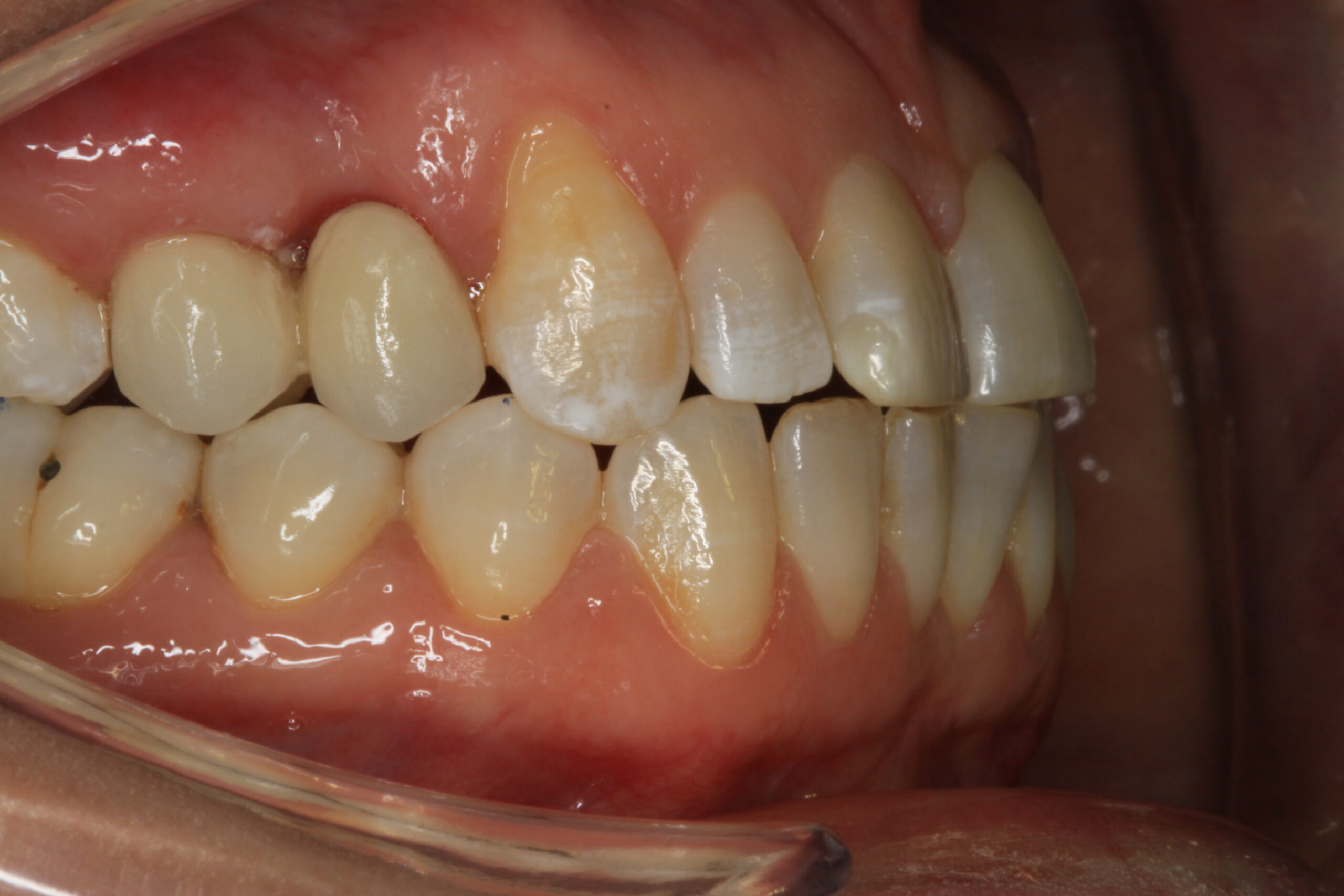 Conventional Bridge Work After scaled Dentist Daventry NHS Exempt and Independent