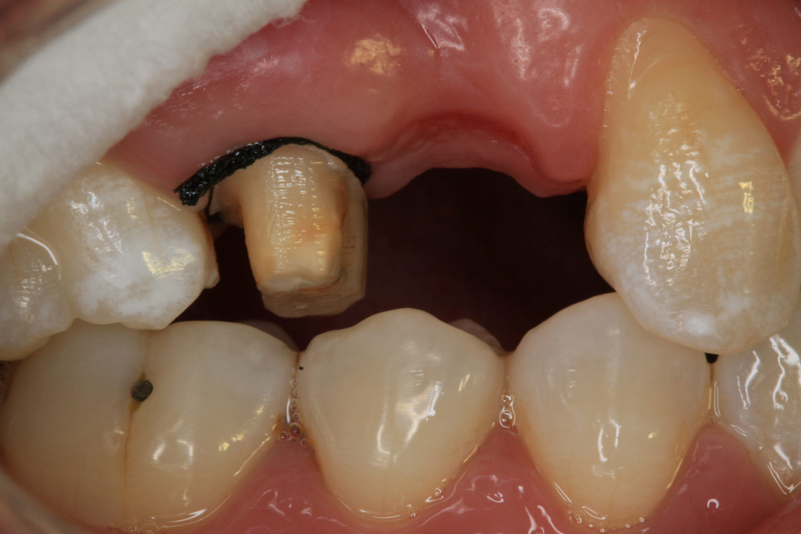 Conventional Bridge Work Before scaled Dentist Daventry NHS Exempt and Independent