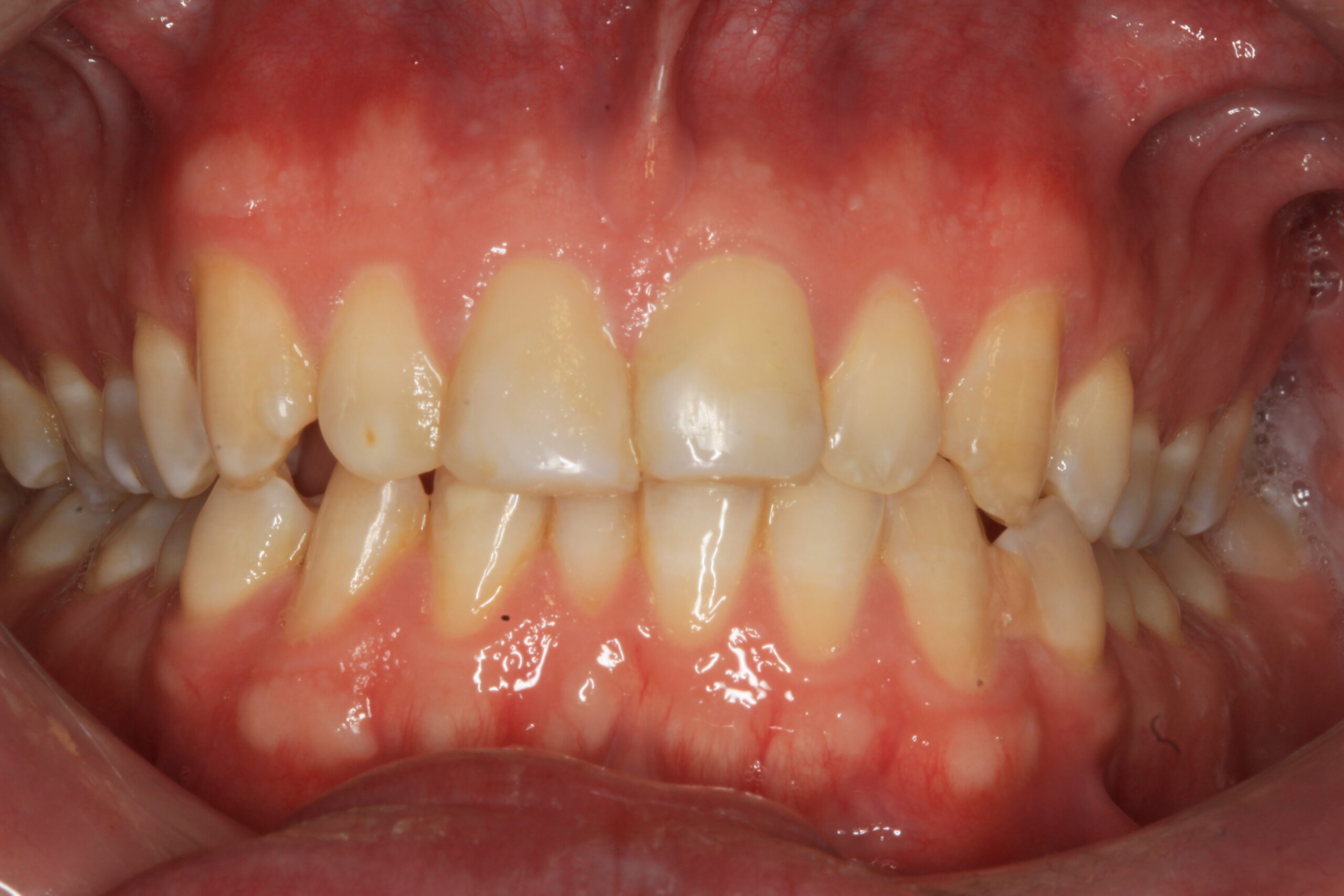 Cosmetic Fillings After scaled Dentist Daventry NHS Exempt and Independent